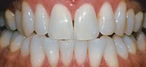 1 After Whitening1