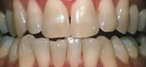 1 Before Whitening1